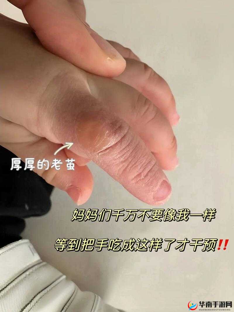 宝宝才三根手指就这么疼：背后的隐情